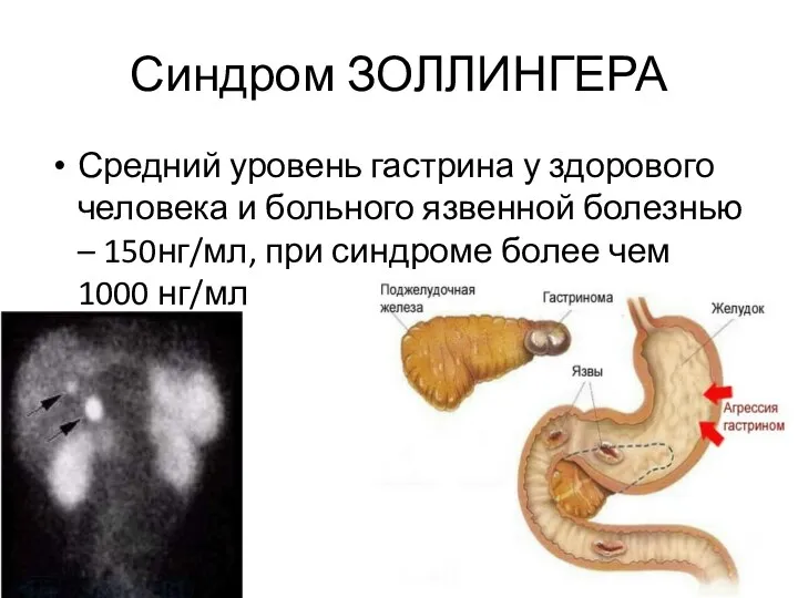 Синдром ЗОЛЛИНГЕРА Средний уровень гастрина у здорового человека и больного