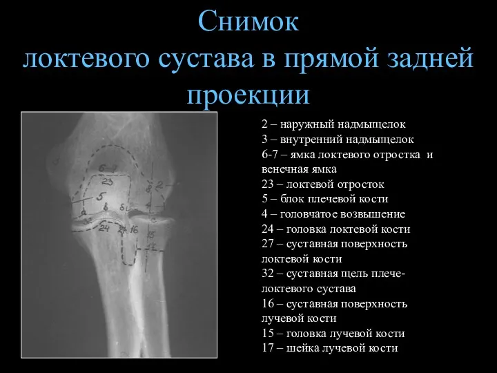 Снимок локтевого сустава в прямой задней проекции 2 – наружный надмыщелок 3 –