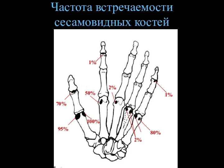 Частота встречаемости сесамовидных костей 6% 95% 100% 70% 1% 50% 2% 2% 80% 1%