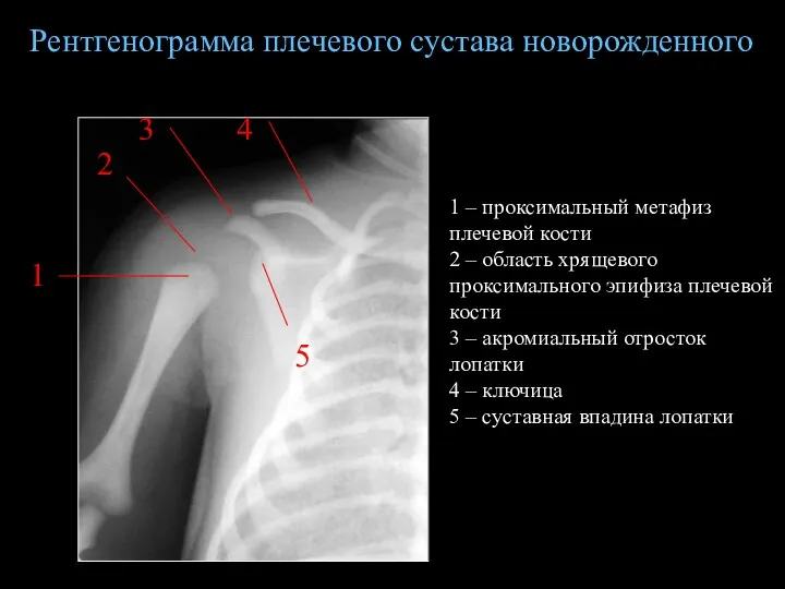 1 – проксимальный метафиз плечевой кости 2 – область хрящевого