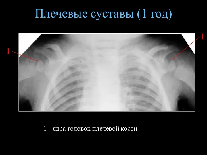 Плечевые суставы (1 год) 1 - ядра головок плечевой кости 1 1