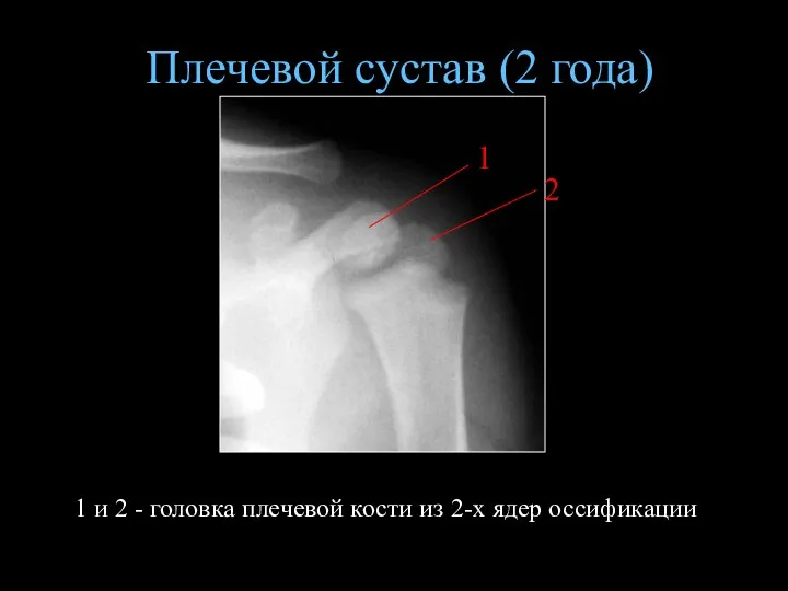 Плечевой сустав (2 года) 1 и 2 - головка плечевой кости из 2-х