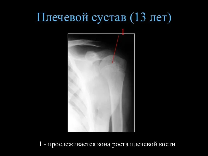 Плечевой сустав (13 лет) 1 - прослеживается зона роста плечевой кости 1