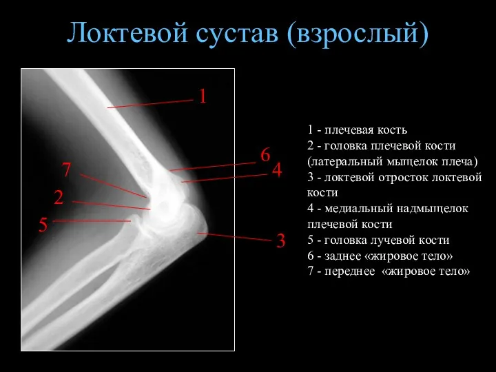 Локтевой сустав (взрослый) 1 - плечевая кость 2 - головка плечевой кости (латеральный