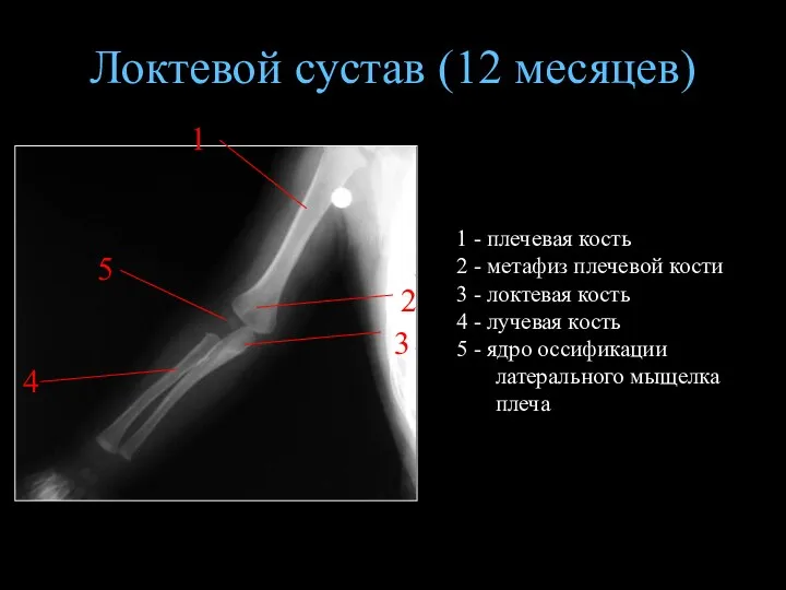 Локтевой сустав (12 месяцев) 1 - плечевая кость 2 - метафиз плечевой кости