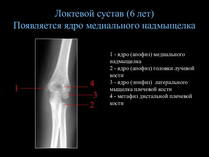 Локтевой сустав (6 лет) Появляется ядро медиального надмыщелка 1 - ядро (апофиз) медиального