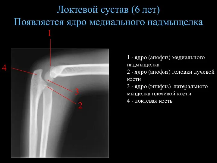 Локтевой сустав (6 лет) Появляется ядро медиального надмыщелка 1 -