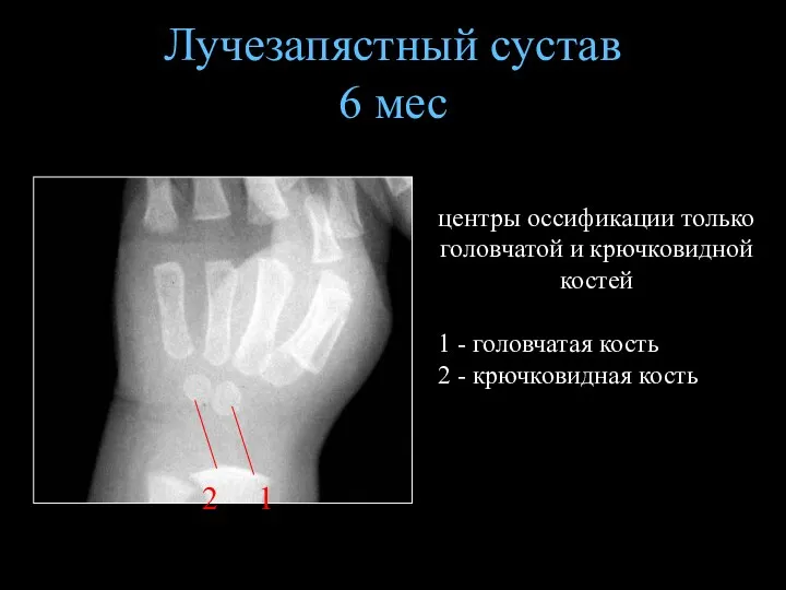 Лучезапястный сустав 6 мес центры оссификации только головчатой и крючковидной