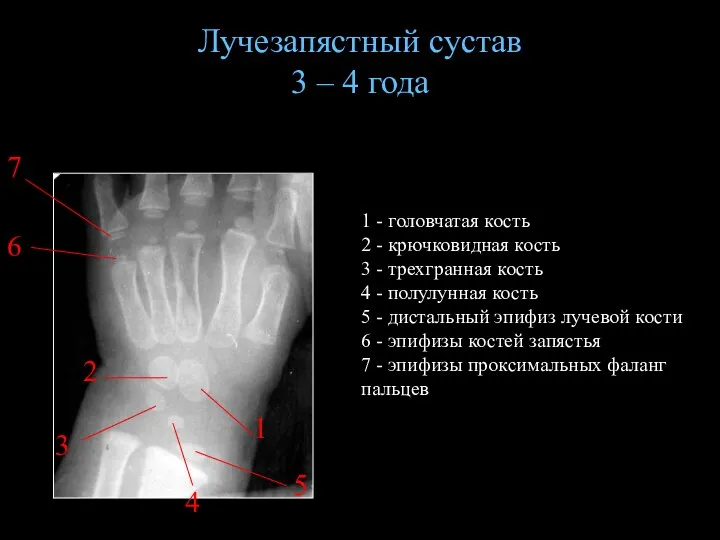 Лучезапястный сустав 3 – 4 года 1 - головчатая кость