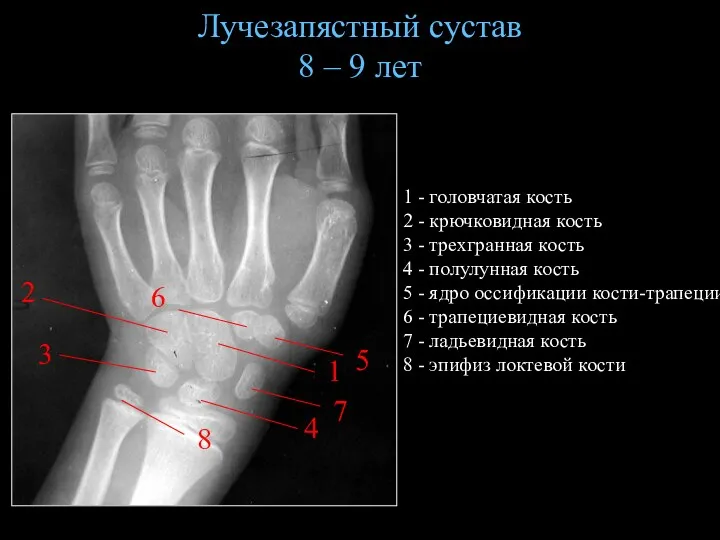 Лучезапястный сустав 8 – 9 лет 1 2 3 1 - головчатая кость
