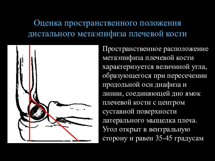Оценка пространственного положения дистального метаэпифиза плечевой кости Пространственное расположение метаэпифиза плечевой кости характеризуется
