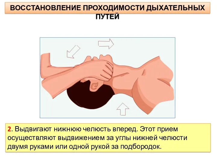 ВОССТАНОВЛЕНИЕ ПРОХОДИМОСТИ ДЫХАТЕЛЬНЫХ ПУТЕЙ 2. Выдвигают нижнюю челюсть вперед. Этот