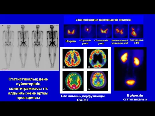 Статистикалық дене сүйектерінің сцинтиграммасы тік алдынғы және артқы проекциясы Бас миының перфузионды ОФЭКТ Буйректің статистикалық сцинтиграфиясы