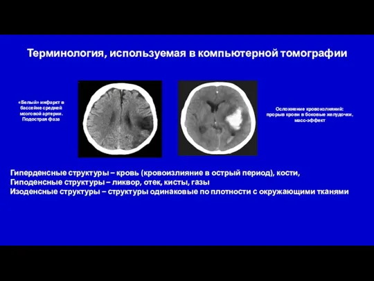 Терминология, используемая в компьютерной томографии Гиперденсные структуры – кровь (кровоизлияние