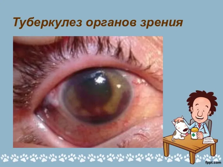 Туберкулез органов зрения