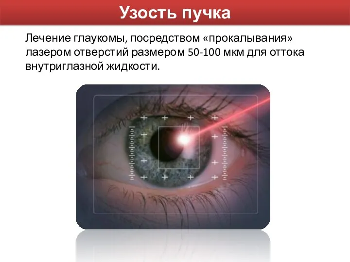 Узость пучка Лечение глаукомы, посредством «прокалывания» лазером отверстий размером 50-100 мкм для оттока внутриглазной жидкости.