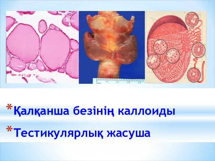 Қалқанша безінің каллоиды Тестикулярлық жасуша