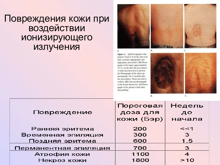 Повреждения кожи при воздействии ионизирующего излучения