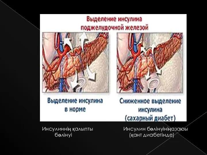 Инсулиннің қалыпты бөлінуі Инсулин бөлінуініңазаюы (қант диабетінде)