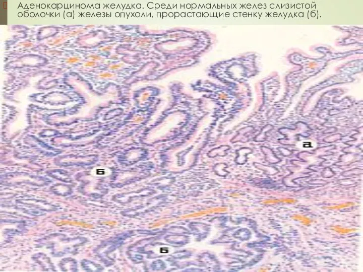 Аденокарцинома желудка. Среди нормальных желез слизистой оболочки (а) железы опухоли, прорастающие стенку желудка (б).
