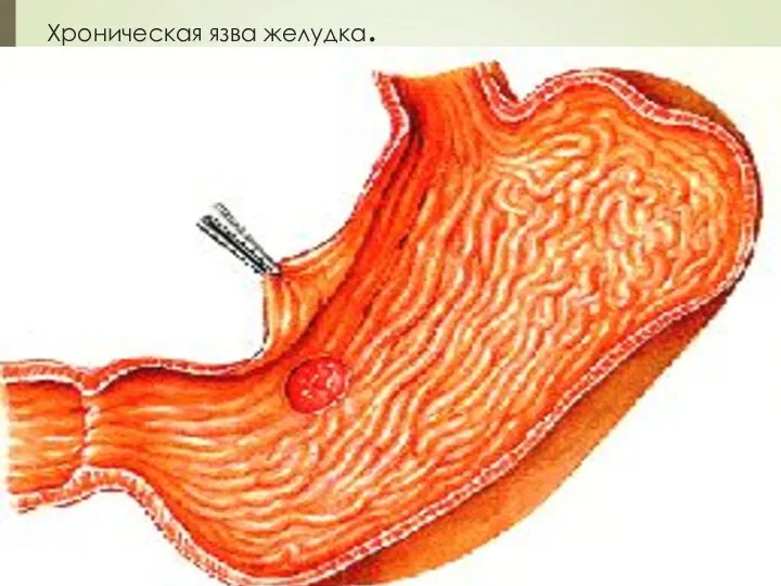 Хроническая язва желудка.