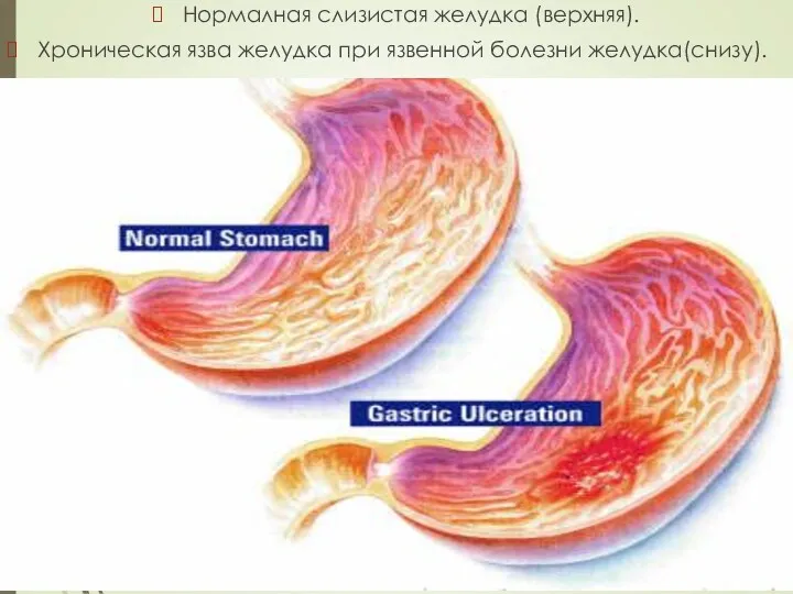 Нормалная слизистая желудка (верхняя). Хроническая язва желудка при язвенной болезни желудка(снизу).