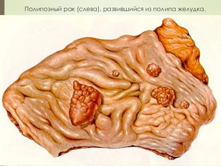Полипозный рак (слева), развившийся из полипа желудка.