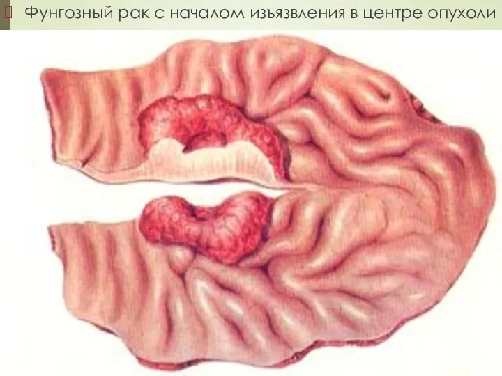 Фунгозный рак с началом изъязвления в центре опухоли