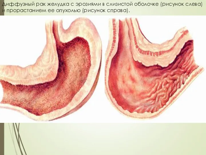 Диффузный рак желудка с эрозиями в слизистой оболочке (рисунок слева) и прорастанием ее опухолью (рисунок справа).