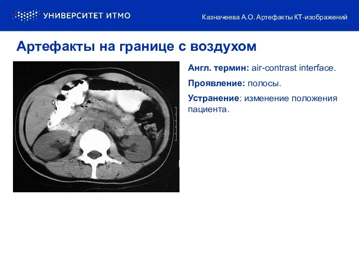 Англ. термин: air-contrast interface. Проявление: полосы. Устранение: изменение положения пациента.