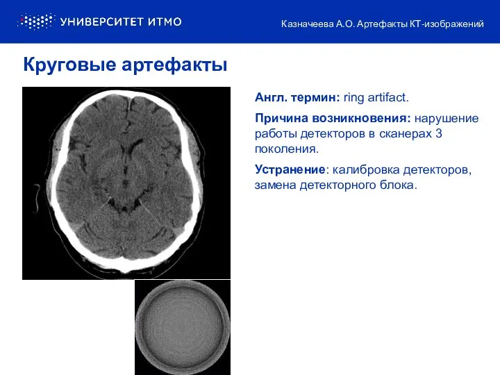 Англ. термин: ring artifact. Причина возникновения: нарушение работы детекторов в