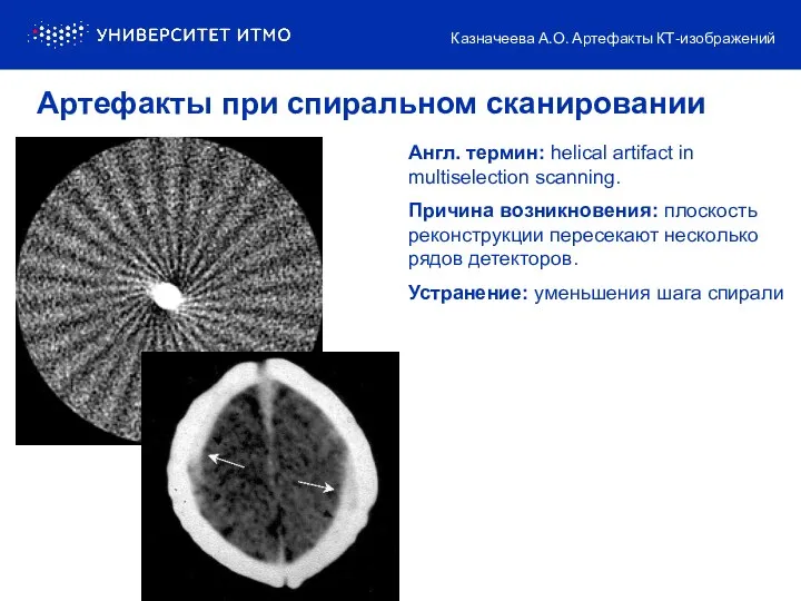 Англ. термин: helical artifact in multiselection scanning. Причина возникновения: плоскость