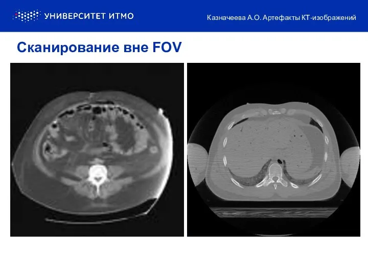 Сканирование вне FOV Казначеева А.О. Артефакты КТ-изображений