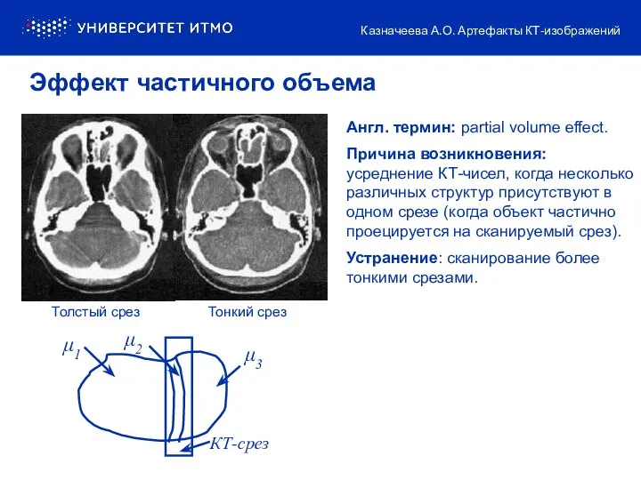 Англ. термин: partial volume effect. Причина возникновения: усреднение КТ-чисел, когда