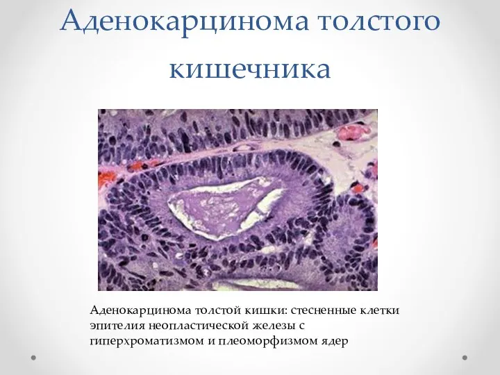 Аденокарцинома толстого кишечника Аденокарцинома толстой кишки: стесненные клетки эпителия неопластической железы с гиперхроматизмом и плеоморфизмом ядер