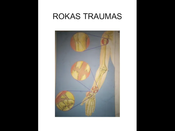 ROKAS TRAUMAS