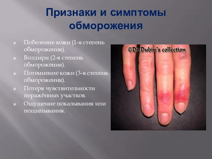 Признаки и симптомы обморожения Побеление кожи (1-я степень обморожения). Волдыри