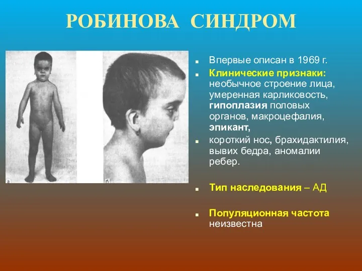 РОБИНОВА СИНДРОМ Впервые описан в 1969 г. Клинические признаки: необычное