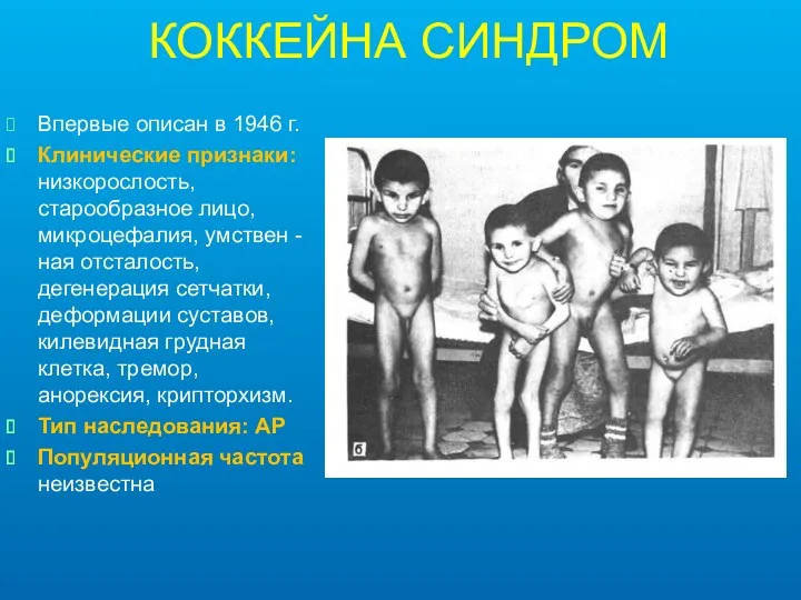 КОККЕЙНА СИНДРОМ Впервые описан в 1946 г. Клинические признаки: низкорослость,