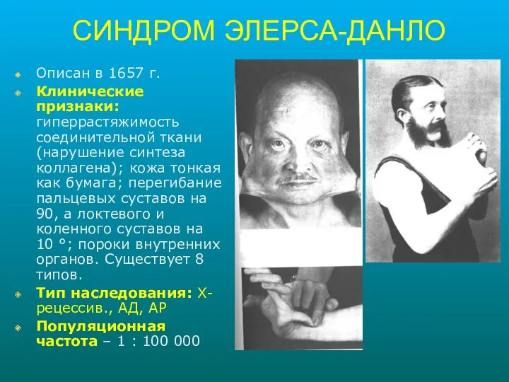 СИНДРОМ ЭЛЕРСА-ДАНЛО Описан в 1657 г. Клинические признаки: гиперрастяжимость соединительной