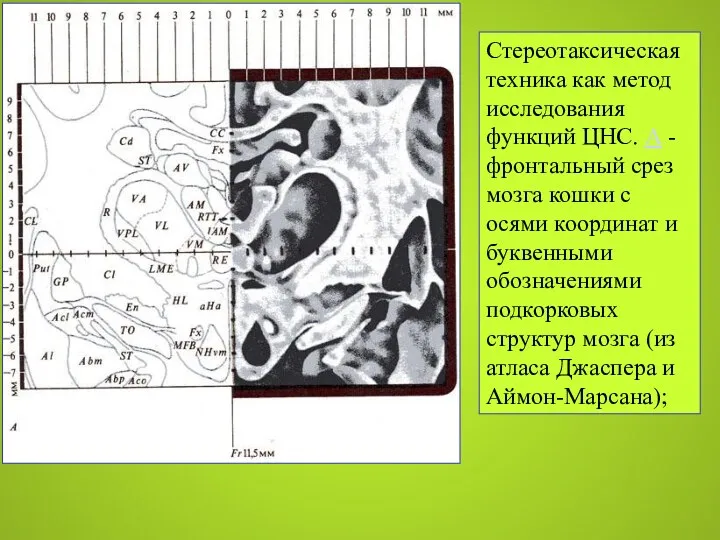 Стереотаксическая техника как метод исследования функций ЦНС. А - фронтальный