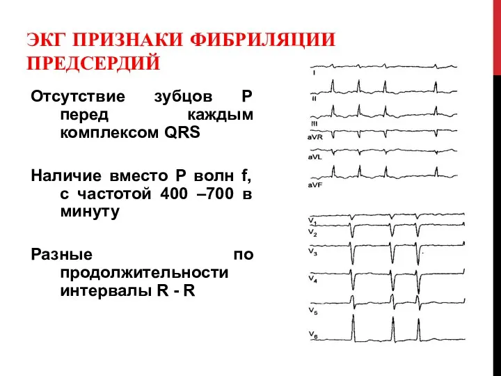 ЭКГ ПРИЗНАКИ ФИБРИЛЯЦИИ ПРЕДСЕРДИЙ Отсутствие зубцов P перед каждым комплексом