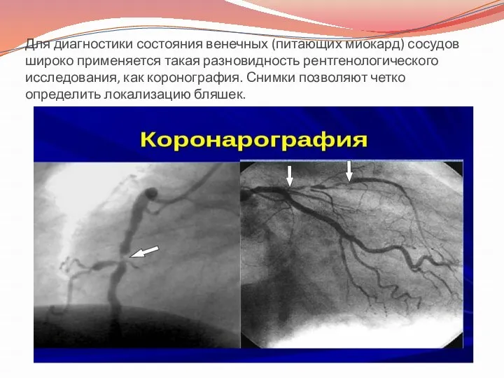 Для диагностики состояния венечных (питающих миокард) сосудов широко применяется такая