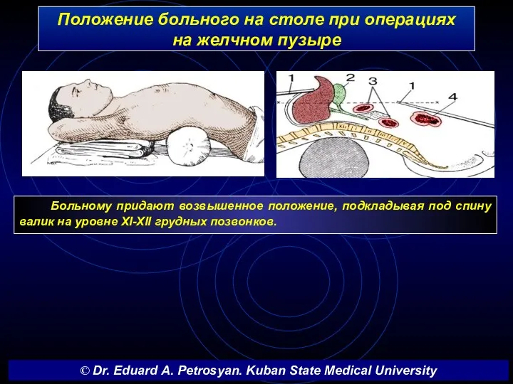 Положение больного на столе при операциях на желчном пузыре Больному