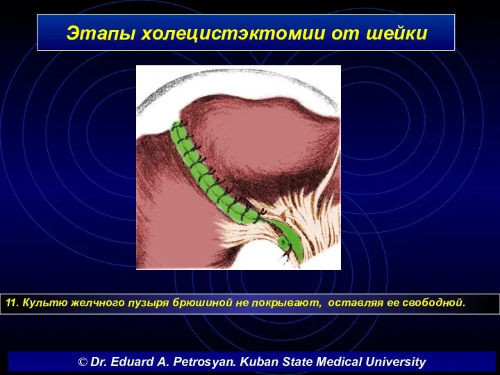 Этапы холецистэктомии от шейки 11. Культю желчного пузыря брюшиной не