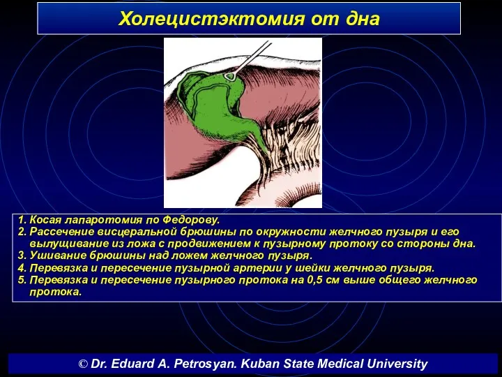 Холецистэктомия от дна 1. Косая лапаротомия по Федорову. 2. Рассечение