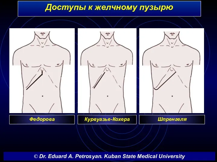 Доступы к желчному пузырю Федорова Курвуазье-Кохера © Dr. Eduard A. Petrosyan. Kuban State Medical University Шпренгеля