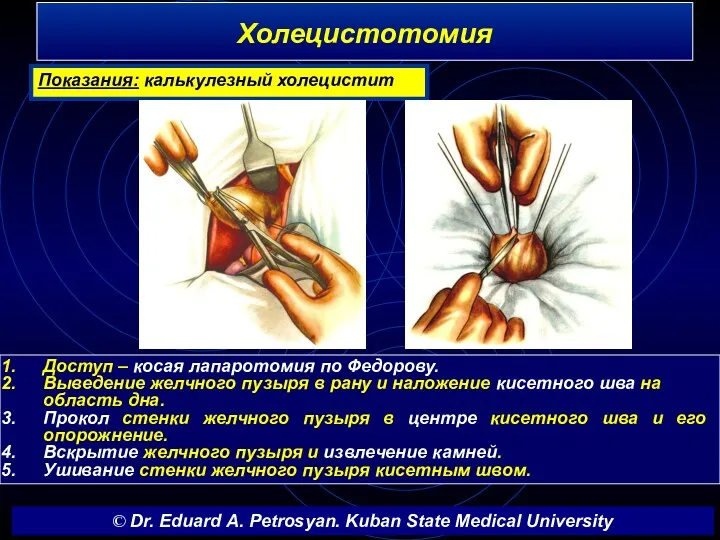 Холецистотомия Доступ – косая лапаротомия по Федорову. Выведение желчного пузыря