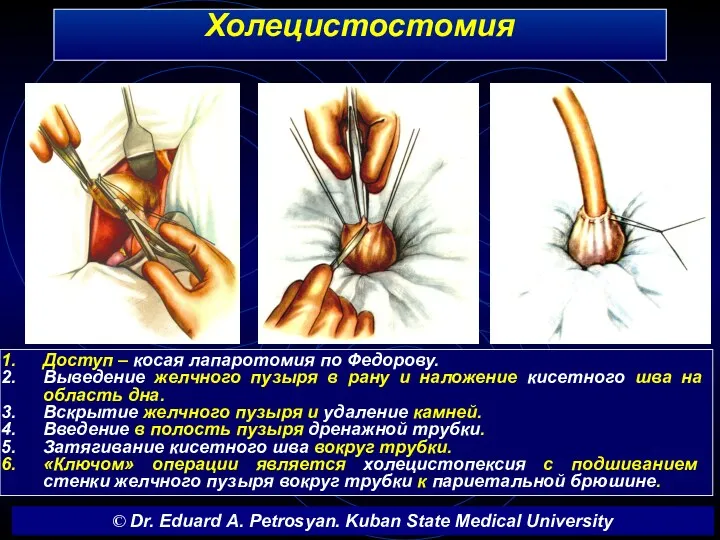 Холецистостомия Доступ – косая лапаротомия по Федорову. Выведение желчного пузыря