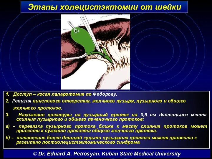 Этапы холецистэктомии от шейки 1. Доступ – косая лапаротомия по